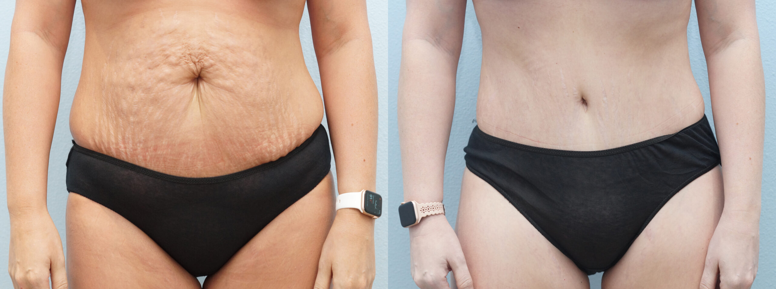 Tummy Tuck Before & After Photos  Neaman Plastic Surgery & Medi Spa