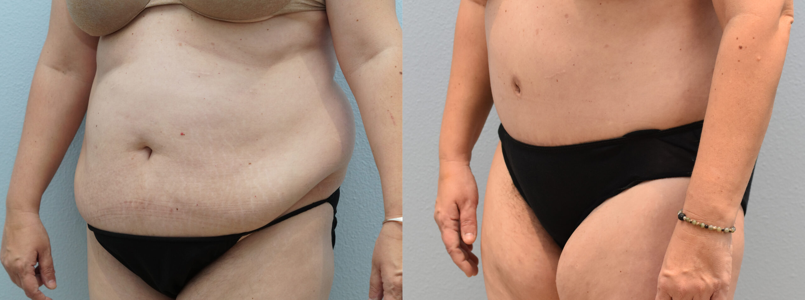 Tummy Tuck Before & After Gallery: Patient 66