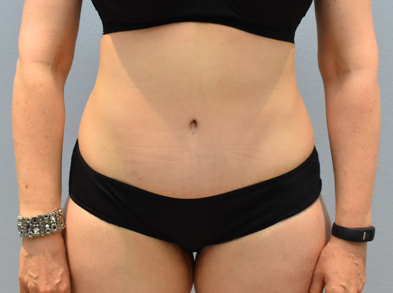 Body Contouring Before and After Photos Salem, OR